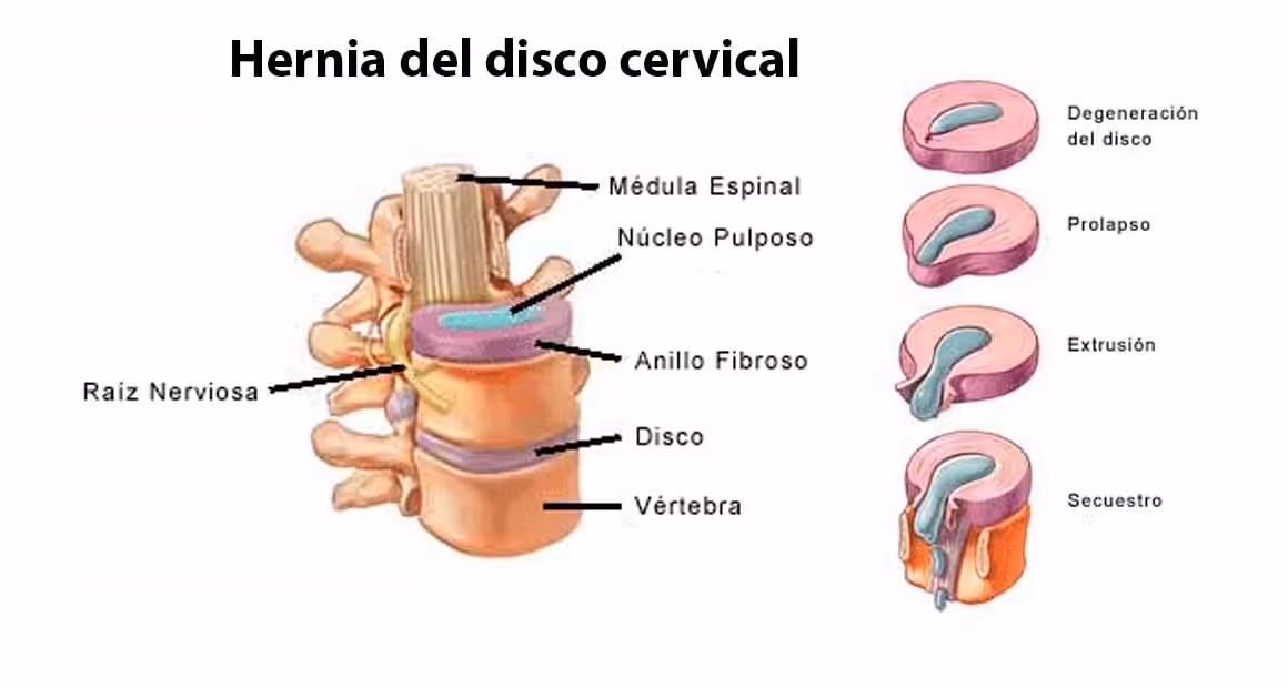 Padecimientos vertebrales comunes