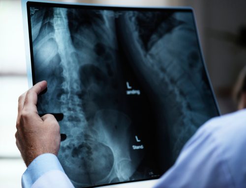 Espondilolistesis Síntomas y Tratamiento