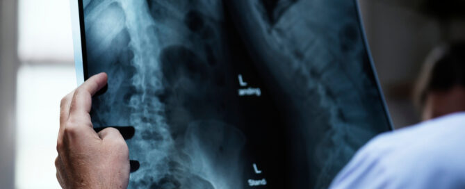 Espondilolistesis Síntomas y Tratamiento